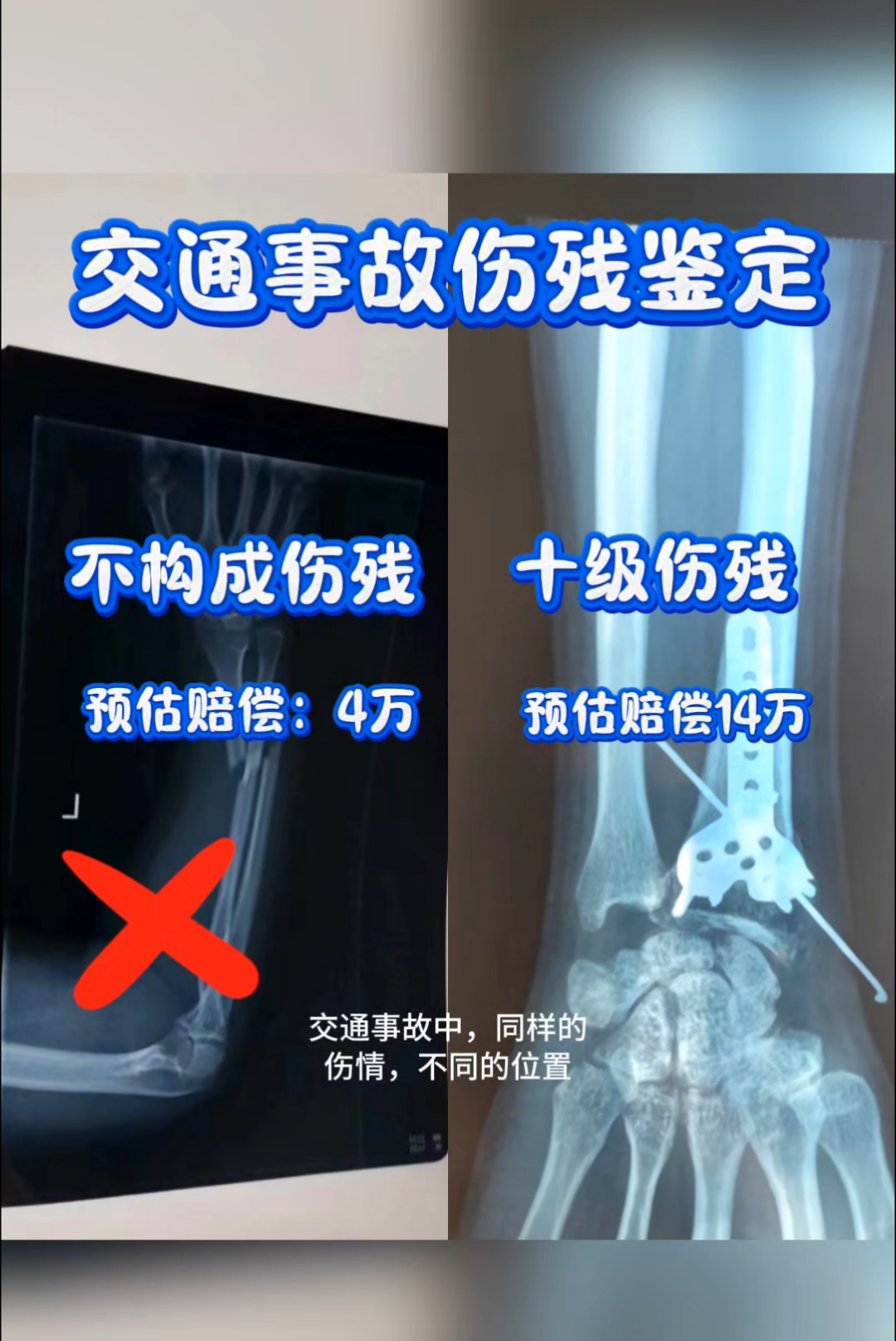 桡骨远端骨折评定伤残案例